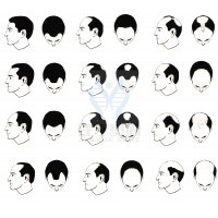 【佳學(xué)基因檢測】過早<font color='red'>脫發(fā)</font>、掉發(fā)太多怎么辦？你的方法可能是錯的！