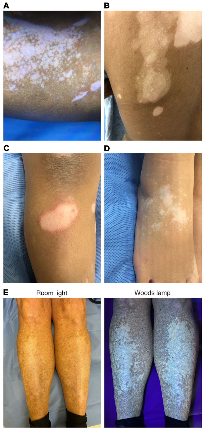 圖 2. 活動性白癜風(fēng)病變的臨床癥狀及其基因檢測