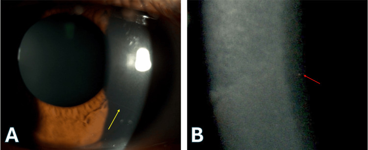 圖2. 明顯的角膜神經(jīng)和點狀深層基質(zhì)混濁。
