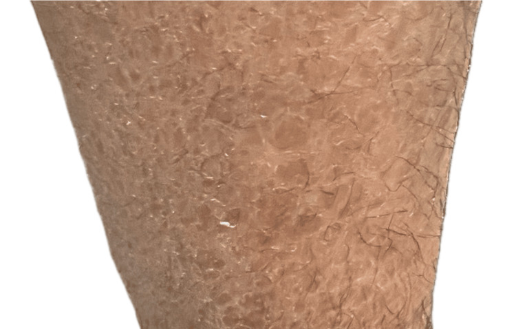 圖1：圖1. 下肢出現(xiàn)多邊形、暗色、鱗狀斑塊伴增厚斑塊。